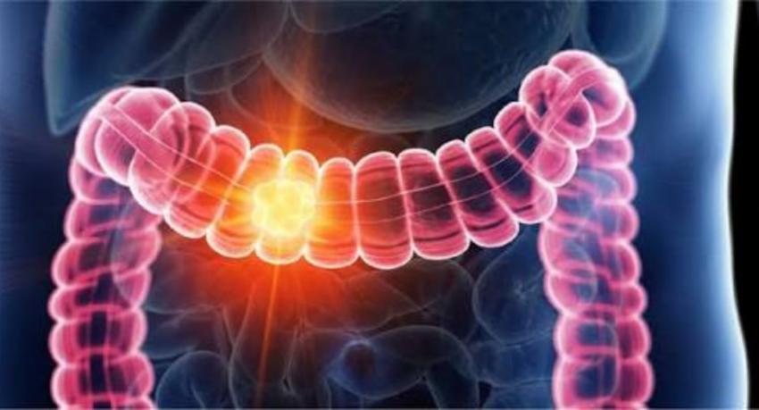 Doctors warn of rising colon and rectal cancers in Sri Lanka