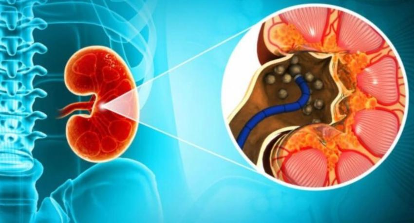 Over 5,000 patients await kidney stone surgery, health minister says